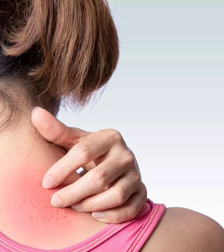 What causes heat rash in adults? What Causes It and How to Treat it?